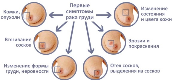 Болит сосочек левый/правый у женщин, девушек-подростков. Почему при нажатии, прикосновении, что делать