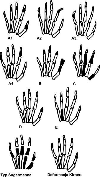 Брахидактилия большого пальца. Тип наследования, операция