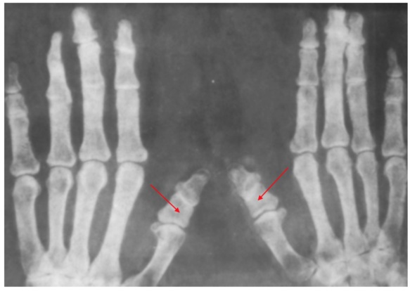 Брахидактилия большого пальца. Тип наследования, операция
