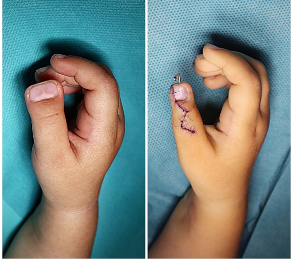 Брахидактилия большого пальца. Тип наследования, операция