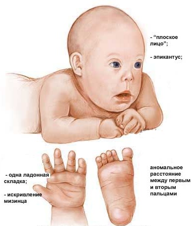 Брахидактилия большого пальца. Тип наследования, операция