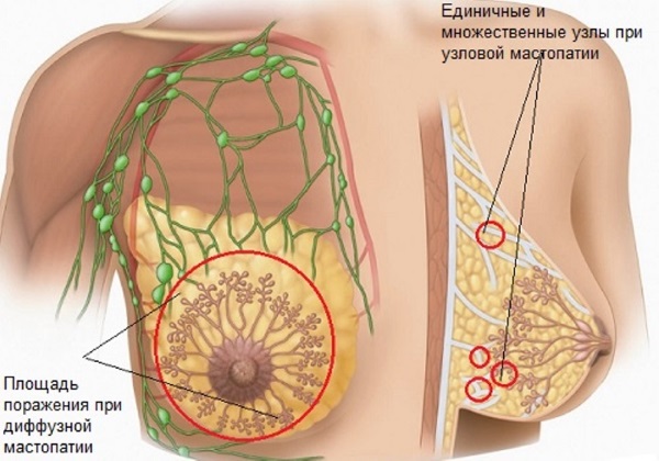 Болит грудь перед месячными, сильно набухает. Почему, что делать