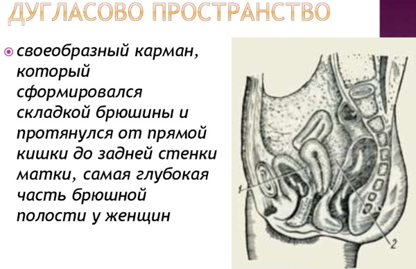 Дугласово пространство в анатомии. Что это, где находится, переднее и заднее, топография, границы, жидкость, метастаз, абсцесс