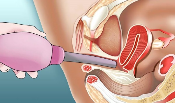 Дугласово пространство в анатомии. Что это, где находится, переднее и заднее, топография, границы, жидкость, метастаз, абсцесс