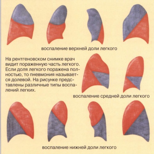 Двухсторонняя пневмония у взрослого, ребенка. Что это такое, симптомы, лечение