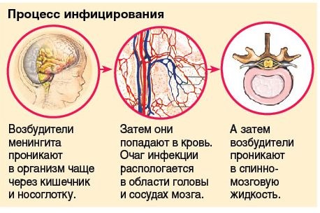 Энтеровирусная инфекция у детей - симптомы и лечение, фото. Как и чем лечить сыпь на коже в домашних условиях, диета, препараты