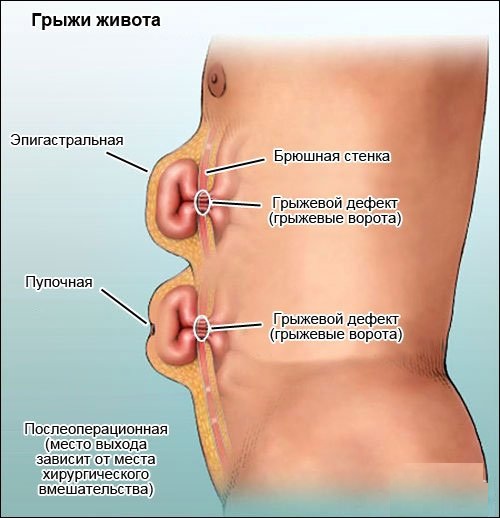 Эпигастральная область. Где это находится, что это такое, почему болит, колит, вздутие, выпирает, спазмы, тяжесть, что делать