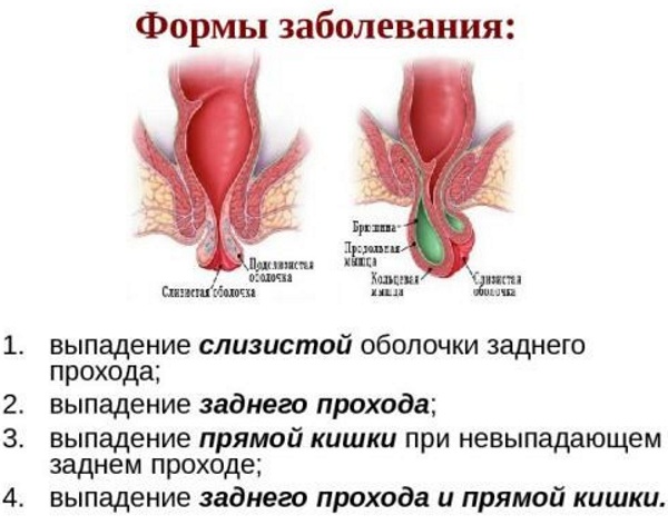 Геморройная шишка вылезла наружу. Какая мазь лучше помогает, чем лечить после родов, при беременности
