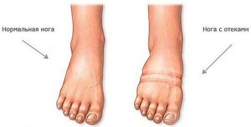 Голеностопный сустав опухает и болит после травмы, бега. Причины, лечение