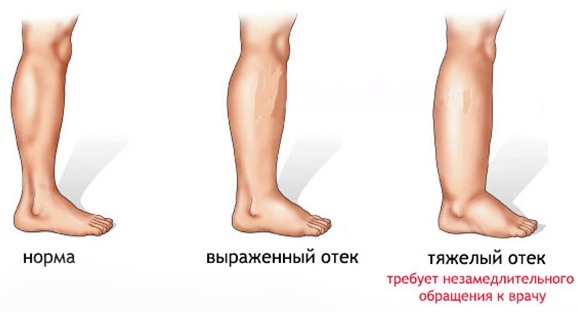 Голеностопный сустав опухает и болит после травмы, бега. Причины, лечение