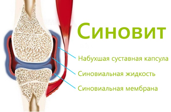 Голеностопный сустав опухает и болит после травмы, бега. Причины, лечение