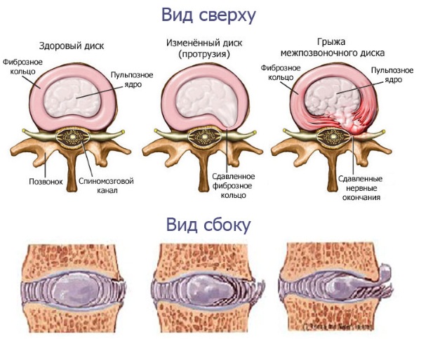 Грыжа позвоночника секвестрированная. Лечение, виды, симптомы, операция по удалению
