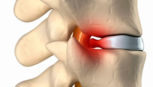 Грыжа позвоночника секвестрированная. Лечение, виды, симптомы, операция по удалению
