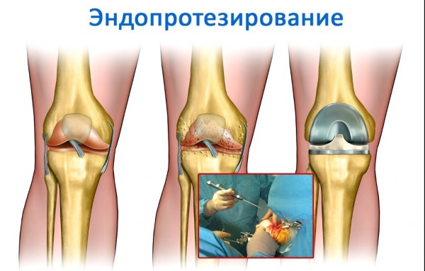 Причины хруста в суставах по всему телу у ребенка, подростка, взрослого. Лечение народными средствами, медикаменты