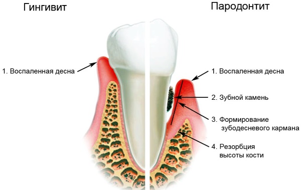 Кислый привкус во рту после еды, с изжогой и без, желтым и белым налетом на языке. Причины и лечение