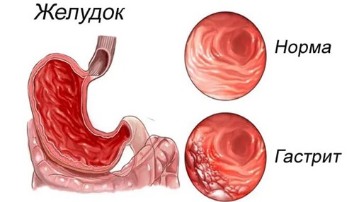 Кислый привкус во рту после еды, с изжогой и без, желтым и белым налетом на языке. Причины и лечение