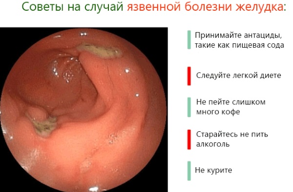 Кислый привкус во рту после еды, с изжогой и без, желтым и белым налетом на языке. Причины и лечение