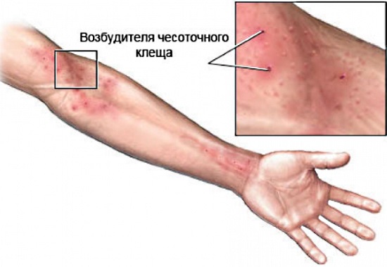 Кора крушины: лечебные свойства, польза для похудения, от запора, для здоровья женщин. Рецепты, как готовить отвар и принимать, противопоказания