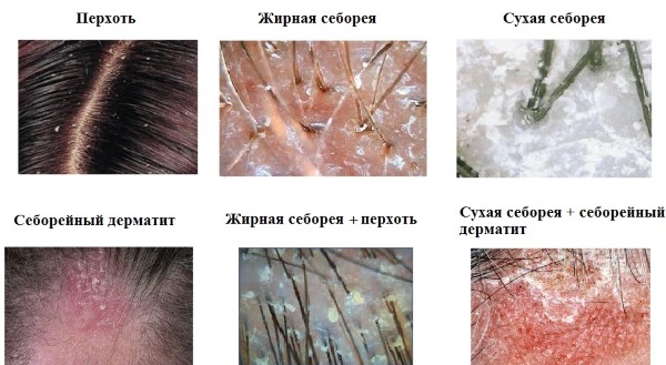 Корень лопуха. Полезные свойства, рецепты для волос, похудения, при онкологии, диабете. Как приготовить и принимать настойку, противопоказания