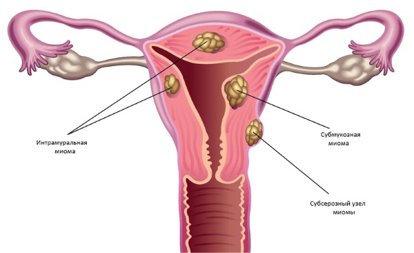 Корень лопуха. Полезные свойства, рецепты для волос, похудения, при онкологии, диабете. Как приготовить и принимать настойку, противопоказания