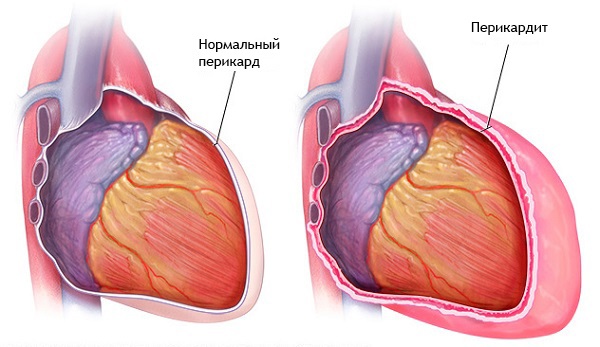 Красная волчанка. Что это за болезнь, симптомы, причины. Как передается, лечение