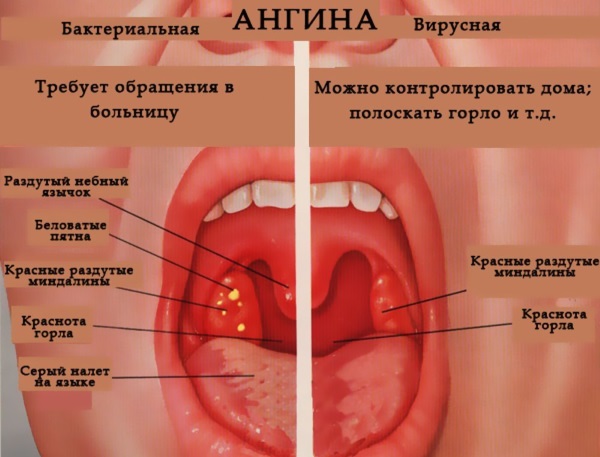 Ангина. Симптомы и лечение у взрослых, лекарства-антибиотики, народные средства