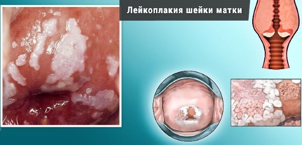 Заболевания шейки матки. Список, классификация, клинические рекомендации