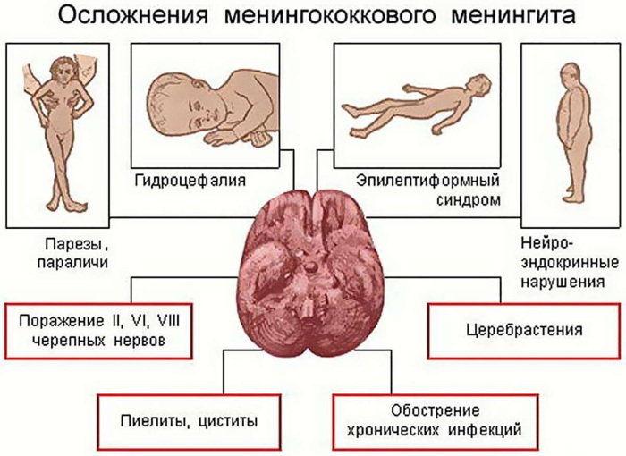 Менингит у подростков. Симптомы, как распознать, лечение