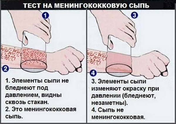 Менингит у подростков. Симптомы, как распознать, лечение