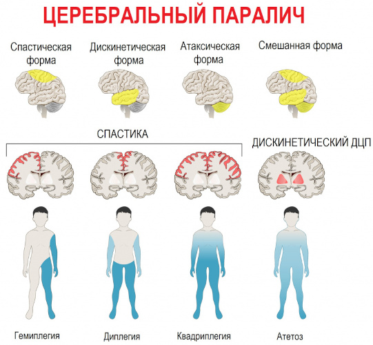 Микроцефалия. Что это за болезнь у детей