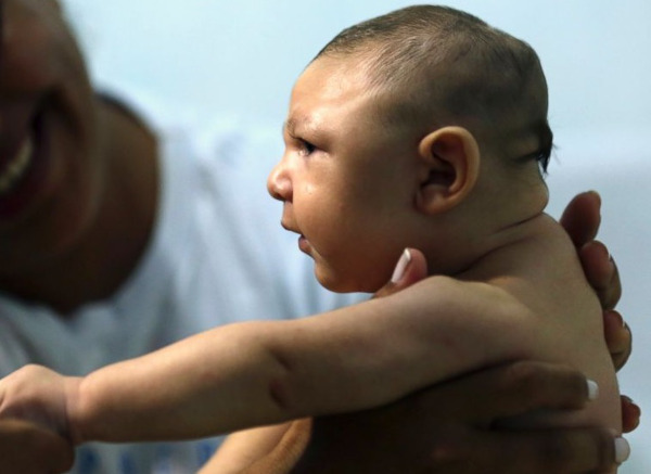 Микроцефалия. Что это за болезнь у детей