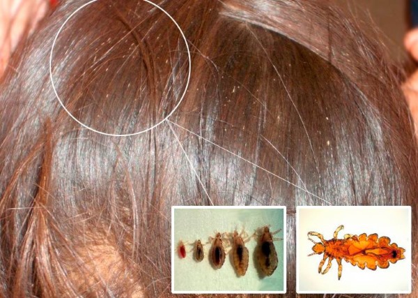 Народные средства от вшей и гнид для детей, взрослым, беременным с уксусом. Что добавить в шампунь