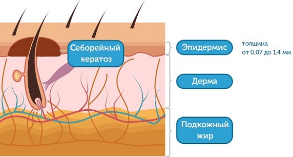 Наросты на коже. Фото и название. Что это и чем лечить