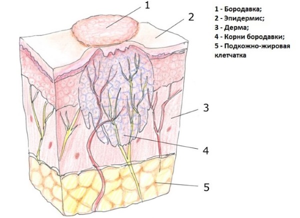 Наросты на коже. Фото и название. Что это и чем лечить