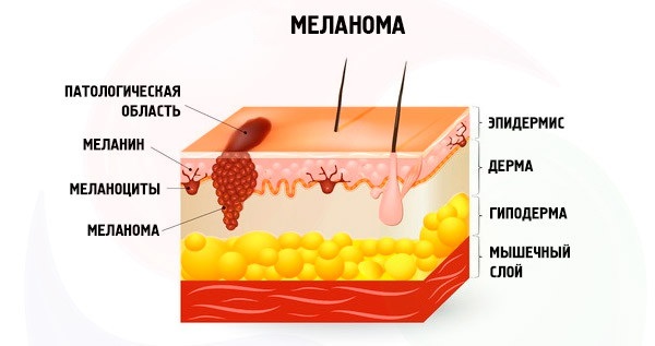 Наросты на коже. Фото и название. Что это и чем лечить