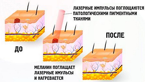 Наросты на коже. Фото и название. Что это и чем лечить
