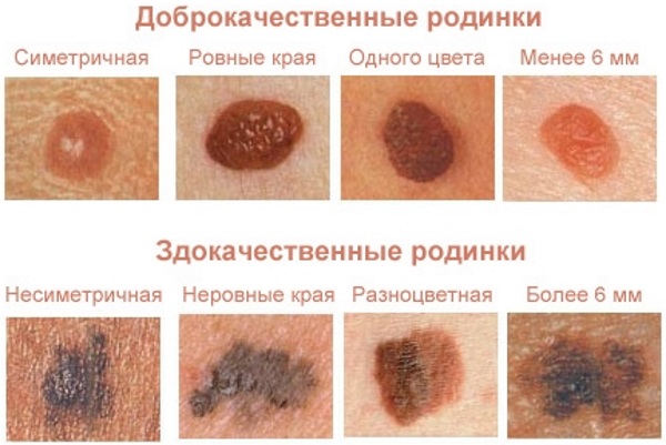 Наросты на коже. Фото и название. Что это и чем лечить