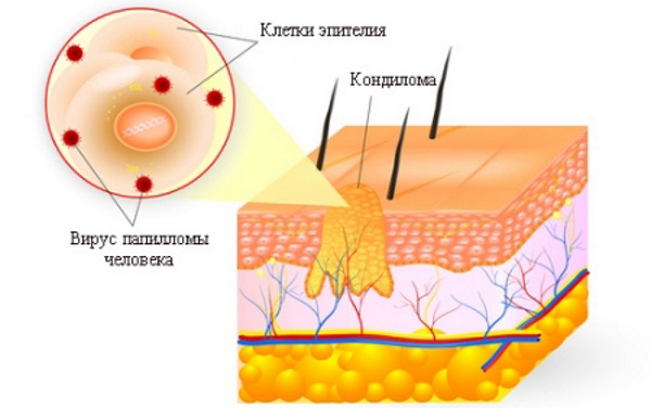 Наросты на коже. Фото и название. Что это и чем лечить