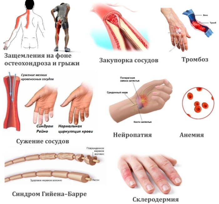 Немеет правая нога ниже колена. Причины, лечение
