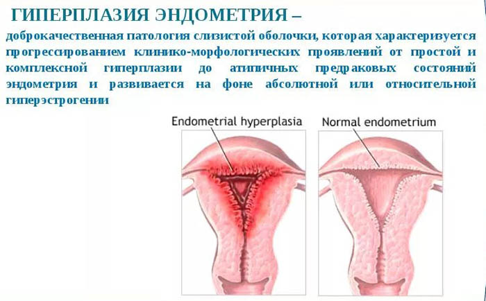 Обильные месячные после Дюфастона. Как остановить, отзывы