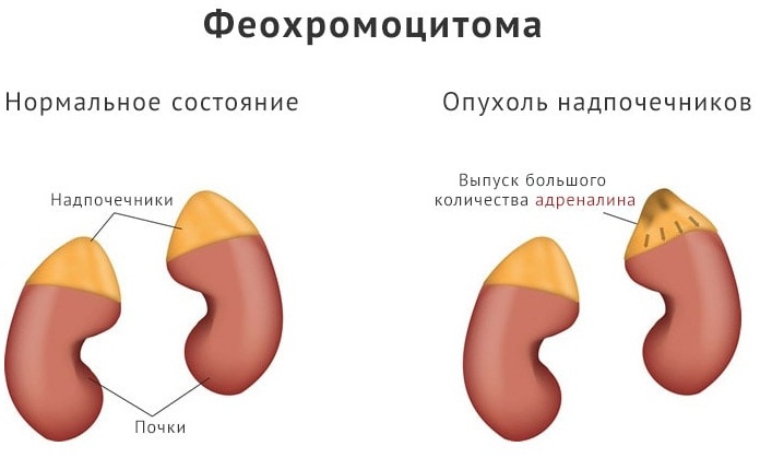 Тахикардия сердца. Причины возникновения, симптомы и лечение