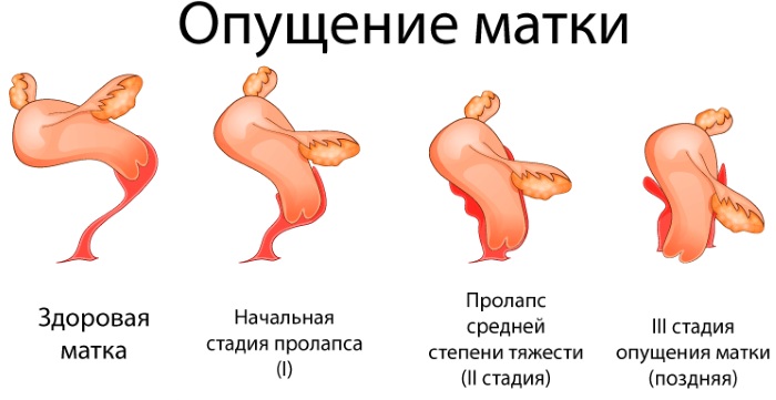 Опущение матки. Симптомы и последствия, лечение, что делать в пожилом возрасте без операции, образ жизни, упражнения