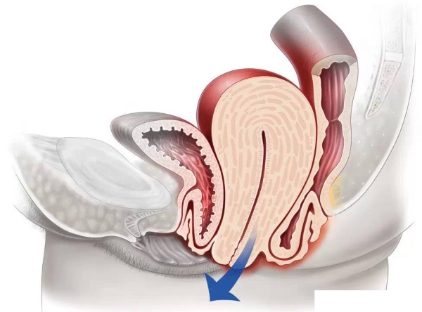 Опущение матки. Симптомы и последствия, лечение, что делать в пожилом возрасте без операции, образ жизни, упражнения