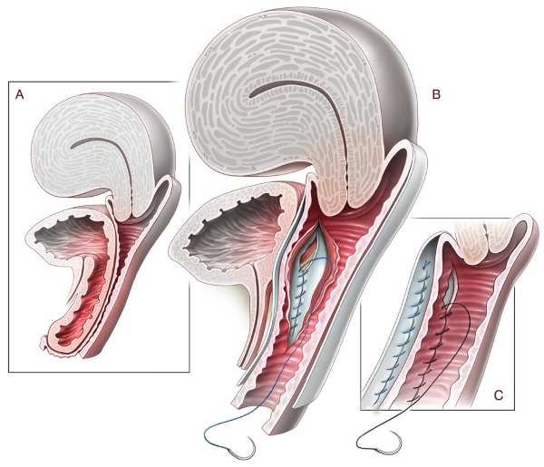 Опущение матки. Симптомы и последствия, лечение, что делать в пожилом возрасте без операции, образ жизни, упражнения