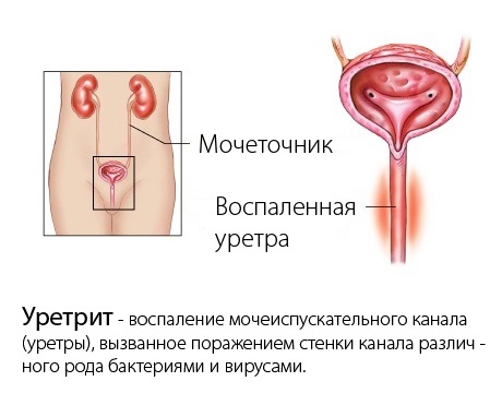 Боли при мочеиспускании у женщин - причины, лечение в домашних условиях. К какому врачу обратиться