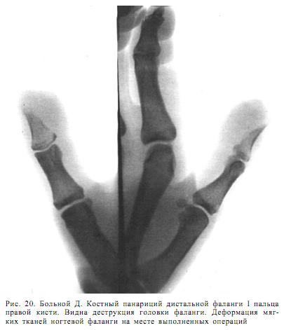 Панариций на пальце руки, ноги. Классификация, лечение, фото