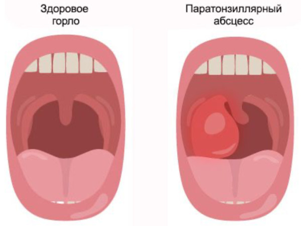 Паратонзиллярный абсцесс горла (паратонзиллит). Фото, лечение