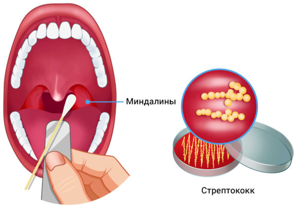 Паратонзиллярный абсцесс горла (паратонзиллит). Фото, лечение