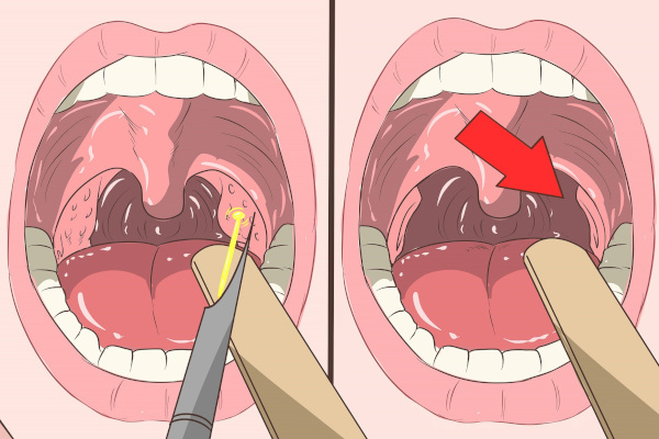 Паратонзиллярный абсцесс горла (паратонзиллит). Фото, лечение