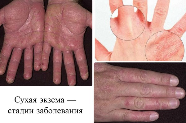 Покраснение и шелушение кожи на груди, под грудью у женщин. Причины, лечение